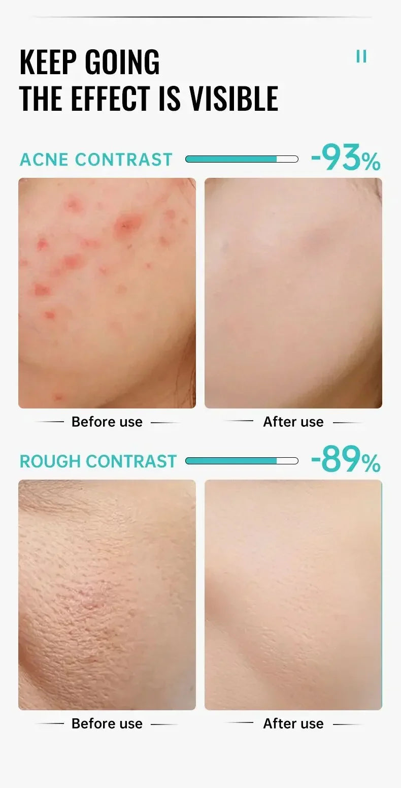 Salicylic Acid Acne Treatment Cream Repair Pimple Spots Deep Cleaning Pore Shrinking Anti-acne Oil Control Moisturizer Skin Care