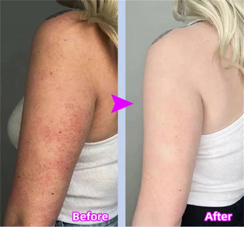 Body Whitening Cream Keratosis Pilaris Treatment Bumpy Rough Chicken Follicle Skin Repair Strawberry Legs Removal Dry Skin Care