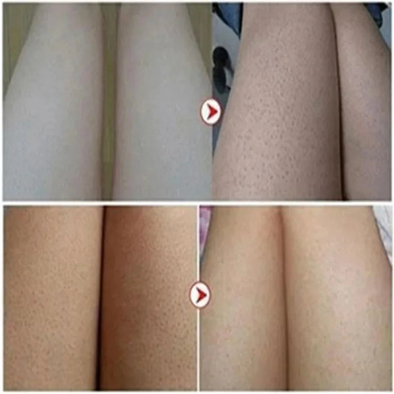 Body Whitening Cream Keratosis Pilaris Treatment Bumpy Rough Chicken Follicle Skin Repair Strawberry Legs Removal Dry Skin Care