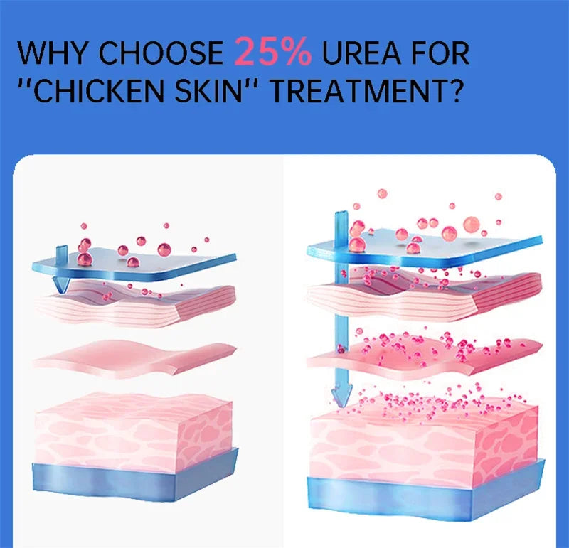 Body Whitening Cream Keratosis Pilaris Treatment Bumpy Rough Chicken Follicle Skin Repair Strawberry Legs Removal Dry Skin Care