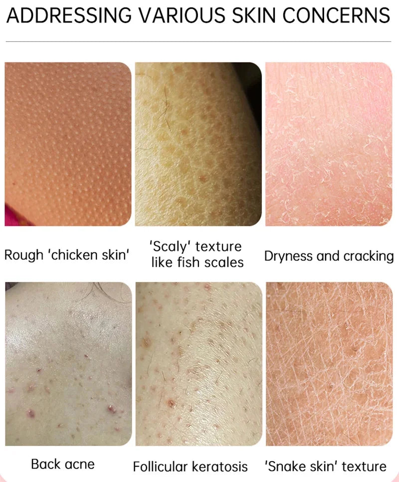 Body Whitening Cream Keratosis Pilaris Treatment Bumpy Rough Chicken Follicle Skin Repair Strawberry Legs Removal Dry Skin Care