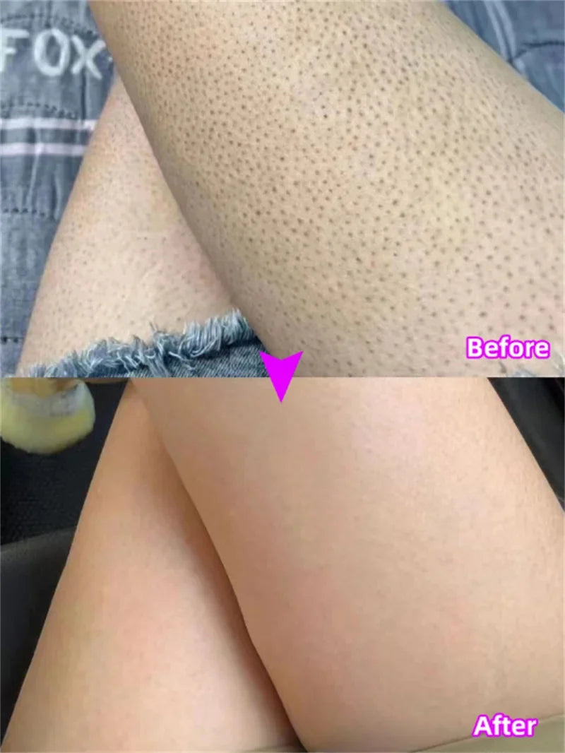 Body Whitening Cream Keratosis Pilaris Treatment Bumpy Rough Chicken Follicle Skin Repair Strawberry Legs Removal Dry Skin Care