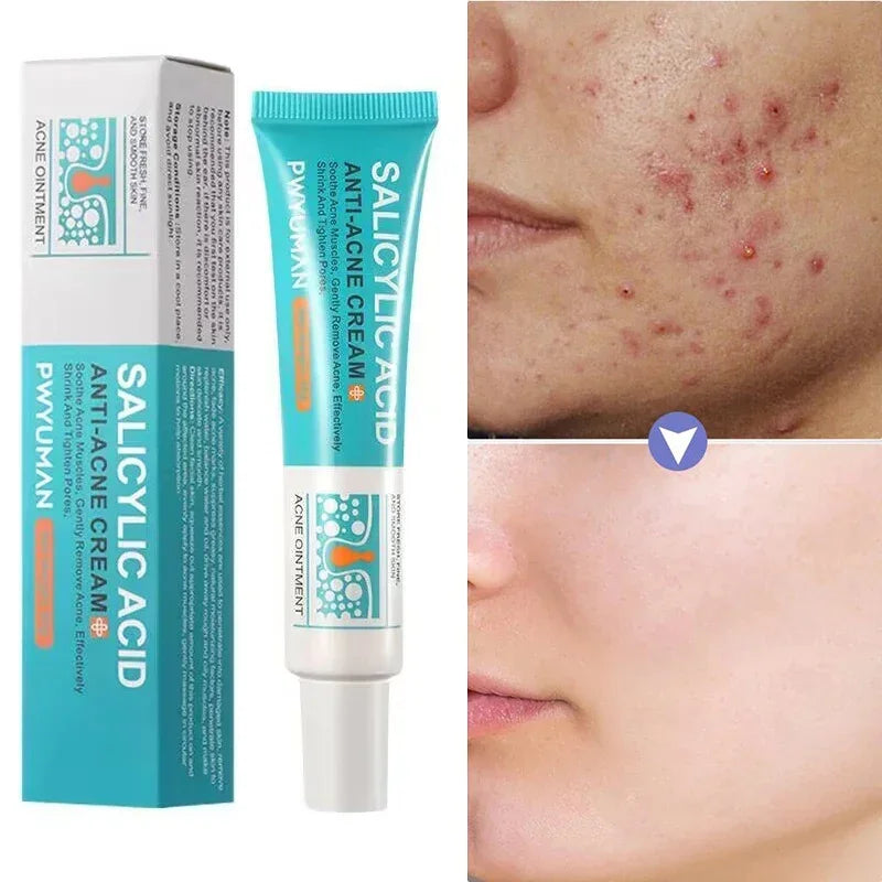 Salicylic Acid Acne Treatment Cream Repair Pimple Spots Deep Cleaning Pore Shrinking Anti-acne Oil Control Moisturizer Skin Care