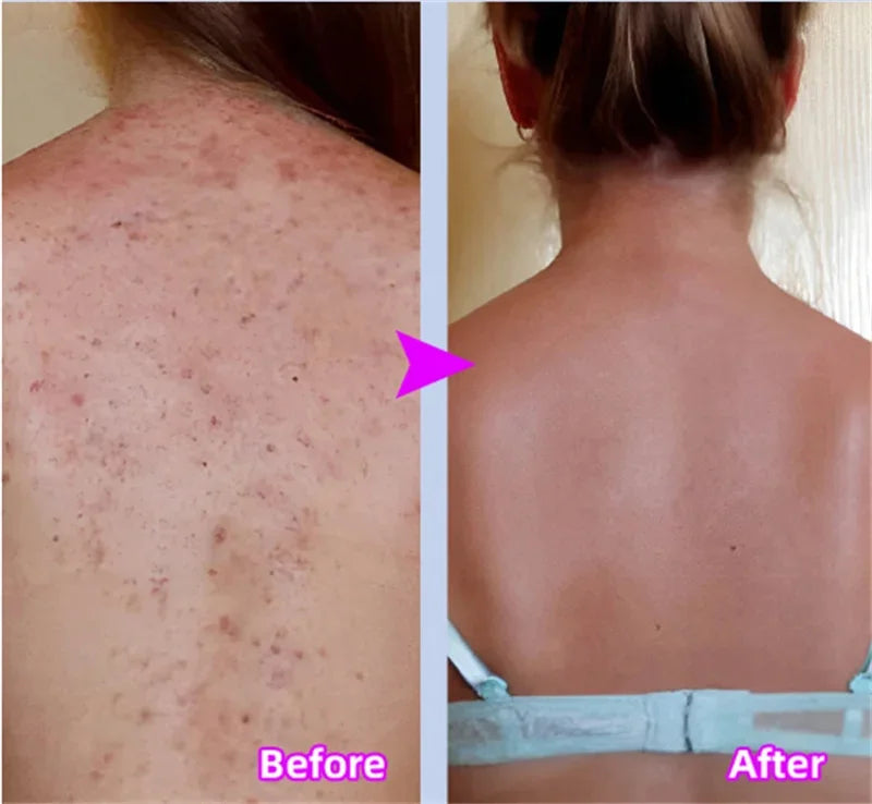 Body Whitening Cream Keratosis Pilaris Treatment Bumpy Rough Chicken Follicle Skin Repair Strawberry Legs Removal Dry Skin Care
